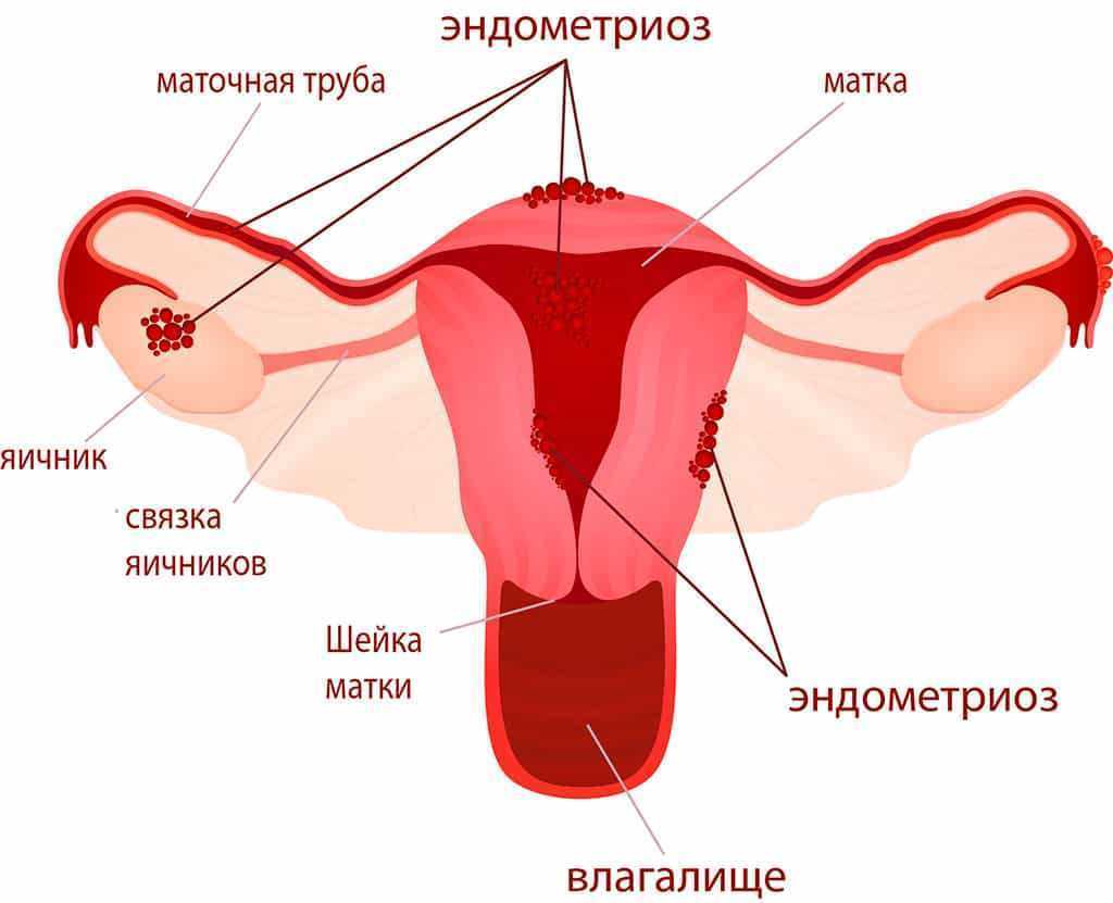 Эндометриоз - подробная схема