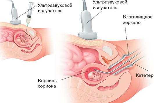 биопсия хориона - использование инструментов