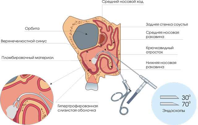 Эндоскопическая гайморотомия