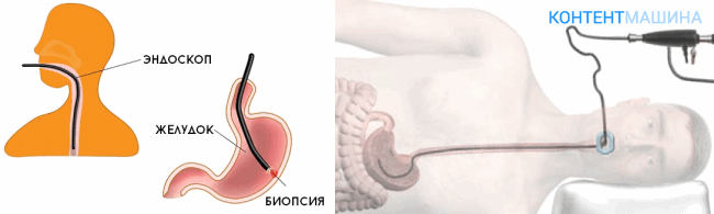 Эндоскопия желудка для диагностики