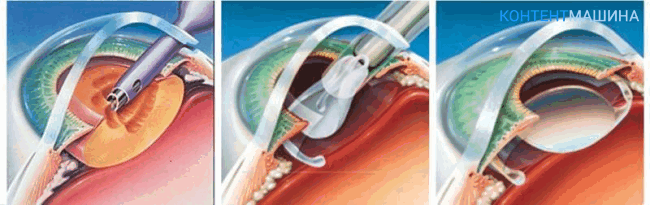как делается операция на глазах