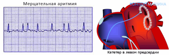 абляция сердца при мерцательной аритмии