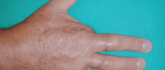 Ампутация пальца или пальцев рук