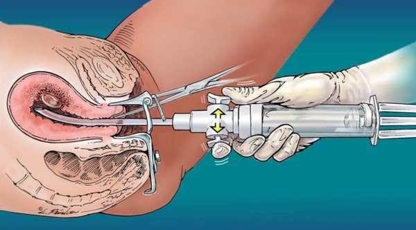 Биопсия эндометрия - как проводится процедура