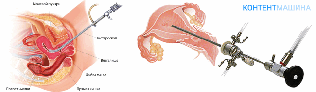 Гистероскопия матки - принцип операции