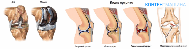 виды артрита коленного сустава