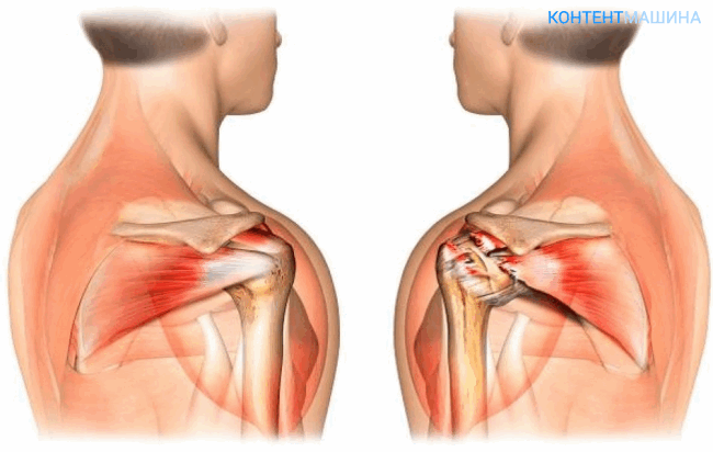 Схема повреждения плечевого сустава 