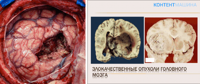 Злокачественная опухоль головного мозга