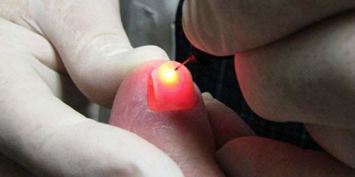 Лазерный метод удаления ногтя