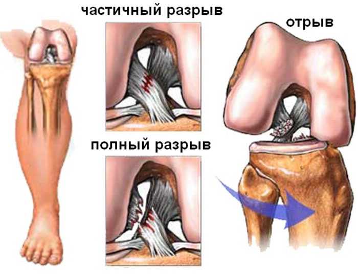 Типы травмы колена